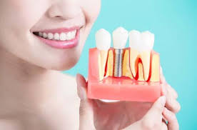 implantacziya-zubiv-u-kliniczi-stomadeus-cherkasy_3